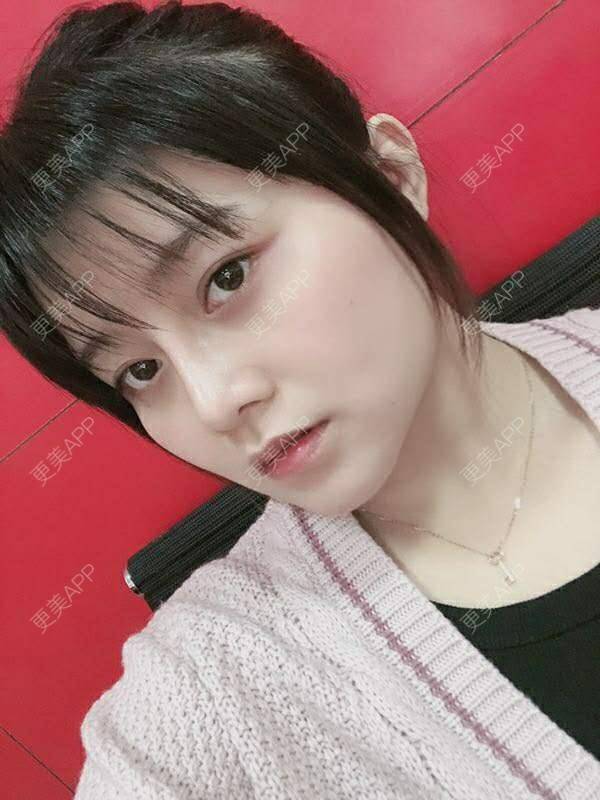 更美 - 小泥泥的吸脂瘦脸经验 | 吸脂瘦脸 | 双下巴吸脂 | 深圳