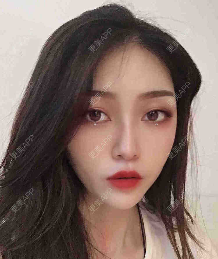 更美 - 芝麻芝麻开开门的自体脂肪全面部填充经验 | 自体脂肪全面部填充 | 视频日记 | 重庆