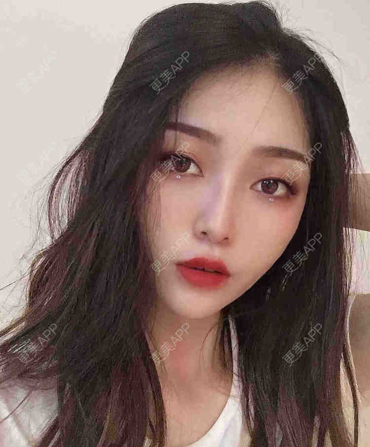 更美 - 芝麻芝麻开开门的自体脂肪全面部填充经验 | 自体脂肪全面部填充 | 视频日记 | 重庆