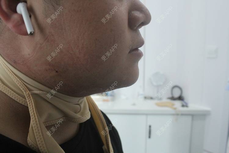更美 - 更美用户W5VhhyGgqG的双下巴吸脂经验 | 双下巴吸脂