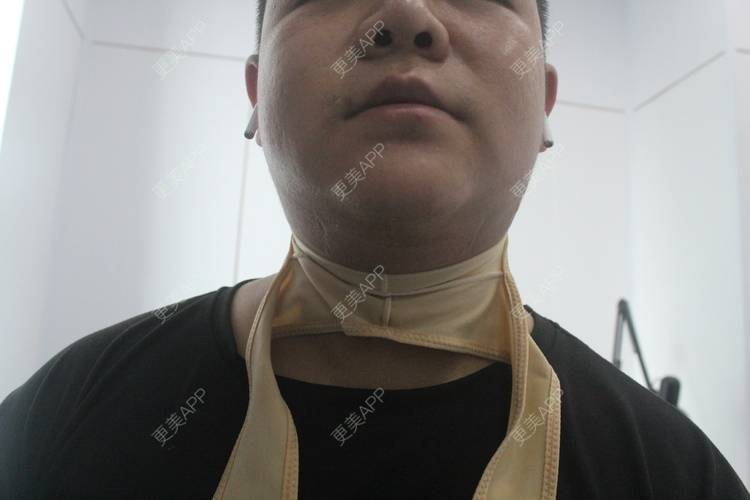 更美 - 更美用户W5VhhyGgqG的双下巴吸脂经验 | 双下巴吸脂