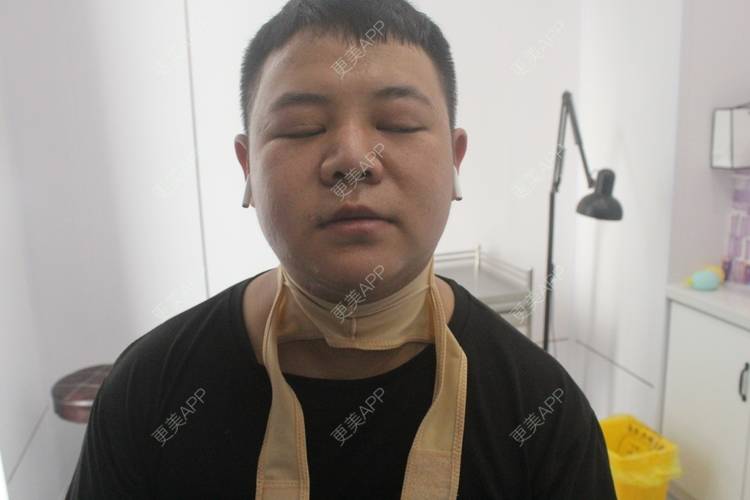 更美 - 更美用户W5VhhyGgqG的双下巴吸脂经验 | 双下巴吸脂