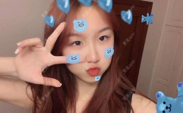 更美 - 更美用户cW7HJd6KJa的激光溶脂瘦脸经验 | 激光溶脂瘦脸