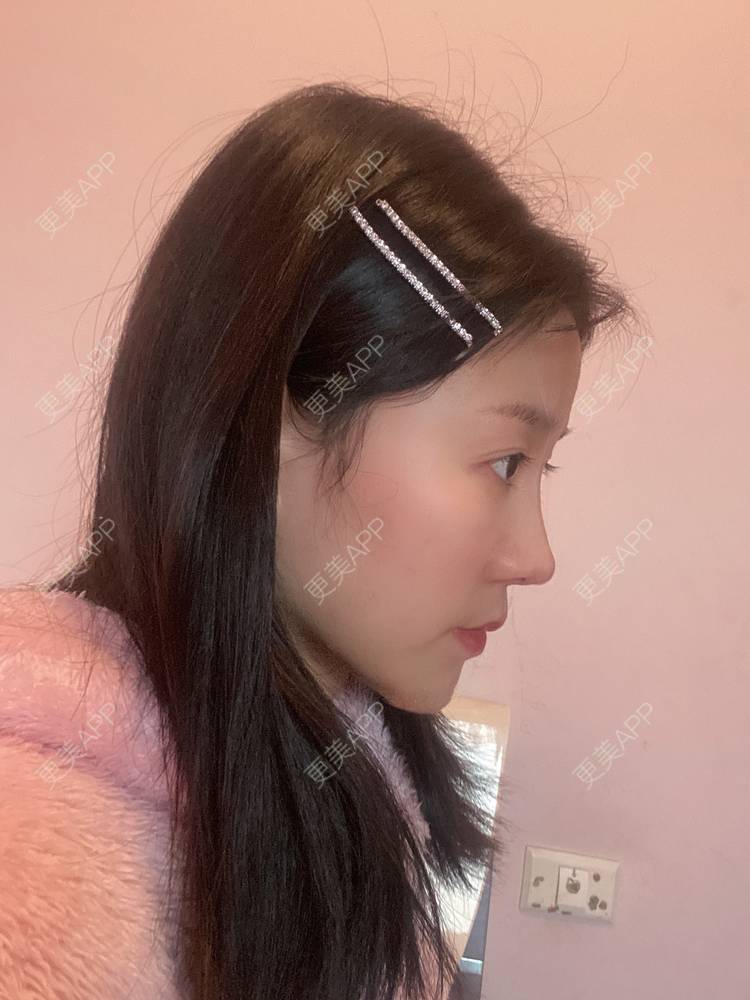 更美 - 更美用户oj8jXDmqrp的鼻部膨体假体取出经验 | 肋软骨隆鼻 | 鼻翼缩小 | 鼻部膨体假体取出 | 鼻形态修复 | 鼻部多项 | 重庆 | 假体垫鼻基底 | 玻尿酸鼻基底 | 自体脂肪垫鼻基底 | 鼻中隔软骨隆鼻 | 鼻部硅胶假体取出 | 耳软骨隆鼻 | 自体肋软骨垫鼻基底