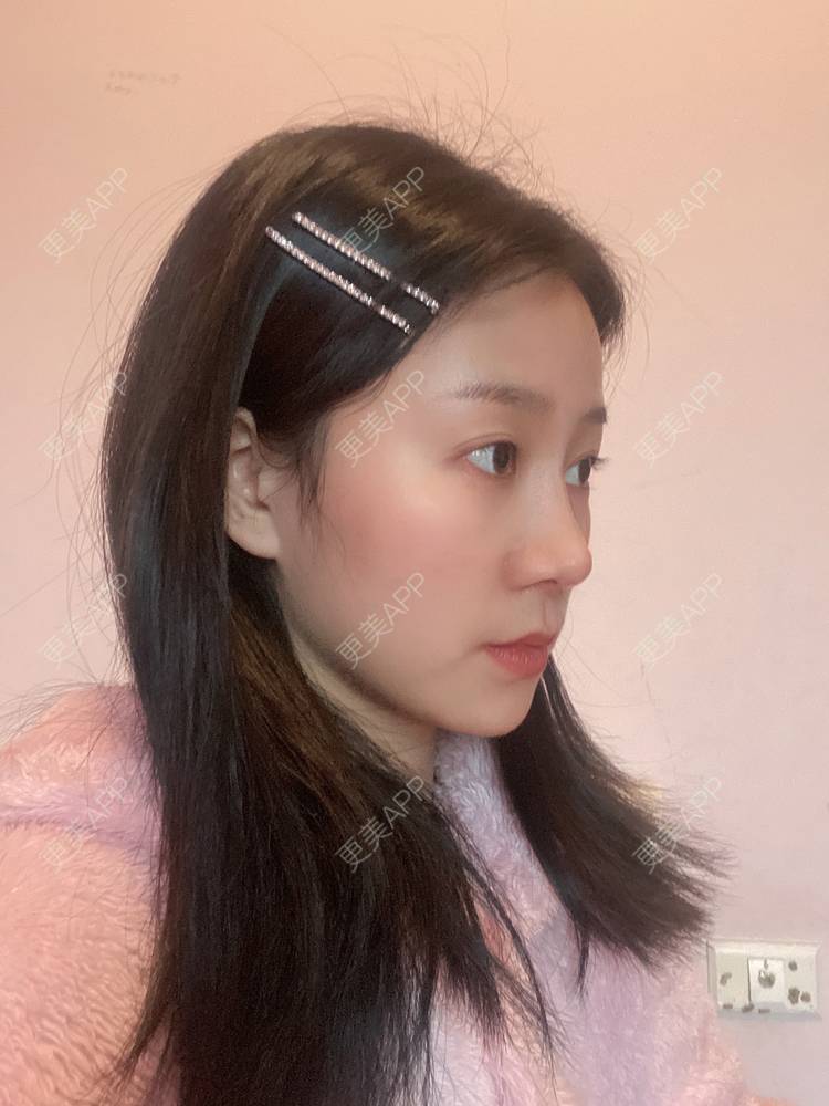 更美 - 更美用户oj8jXDmqrp的鼻部膨体假体取出经验 | 肋软骨隆鼻 | 鼻翼缩小 | 鼻部膨体假体取出 | 鼻形态修复 | 鼻部多项 | 重庆 | 假体垫鼻基底 | 玻尿酸鼻基底 | 自体脂肪垫鼻基底 | 鼻中隔软骨隆鼻 | 鼻部硅胶假体取出 | 耳软骨隆鼻 | 自体肋软骨垫鼻基底