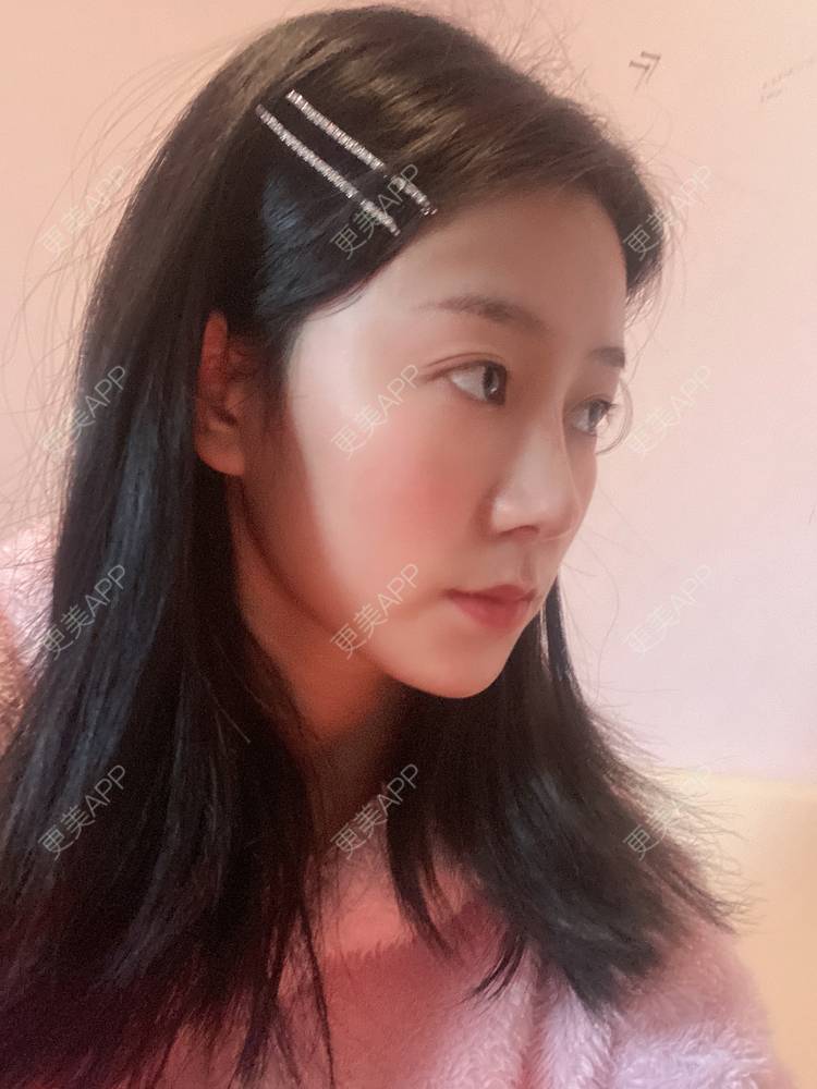 更美 - 更美用户oj8jXDmqrp的鼻部膨体假体取出经验 | 肋软骨隆鼻 | 鼻翼缩小 | 鼻部膨体假体取出 | 鼻形态修复 | 鼻部多项 | 重庆 | 假体垫鼻基底 | 玻尿酸鼻基底 | 自体脂肪垫鼻基底 | 鼻中隔软骨隆鼻 | 鼻部硅胶假体取出 | 耳软骨隆鼻 | 自体肋软骨垫鼻基底