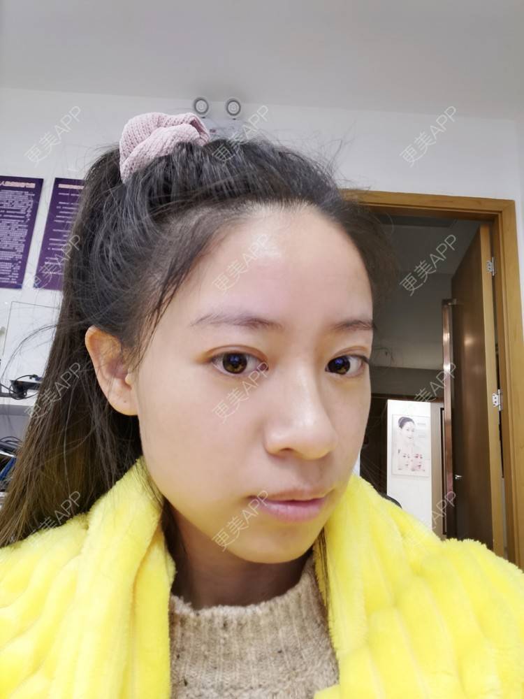 更美 - 更美用户FKgNeqD2Py的黑脸娃娃经验 | 白瓷娃娃 | 美白套餐 | 彩光嫩肤 | 光子嫩肤 | 黑脸娃娃 | 重庆 | 点阵激光 | 注射美白 | 镭射净肤 | 果酸焕肤 | 激光淡斑