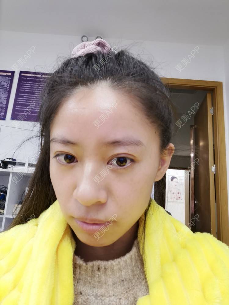 更美 - 更美用户FKgNeqD2Py的黑脸娃娃经验 | 美白套餐 | 白瓷娃娃 | 光子嫩肤 | 彩光嫩肤 | 黑脸娃娃 | 重庆 | 点阵激光 | 注射美白 | 镭射净肤 | 果酸焕肤 | 激光淡斑