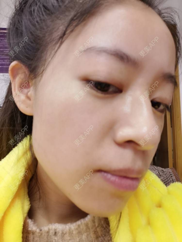 更美 - 更美用户FKgNeqD2Py的黑脸娃娃经验 | 美白套餐 | 白瓷娃娃 | 光子嫩肤 | 彩光嫩肤 | 黑脸娃娃 | 重庆 | 点阵激光 | 注射美白 | 镭射净肤 | 果酸焕肤 | 激光淡斑