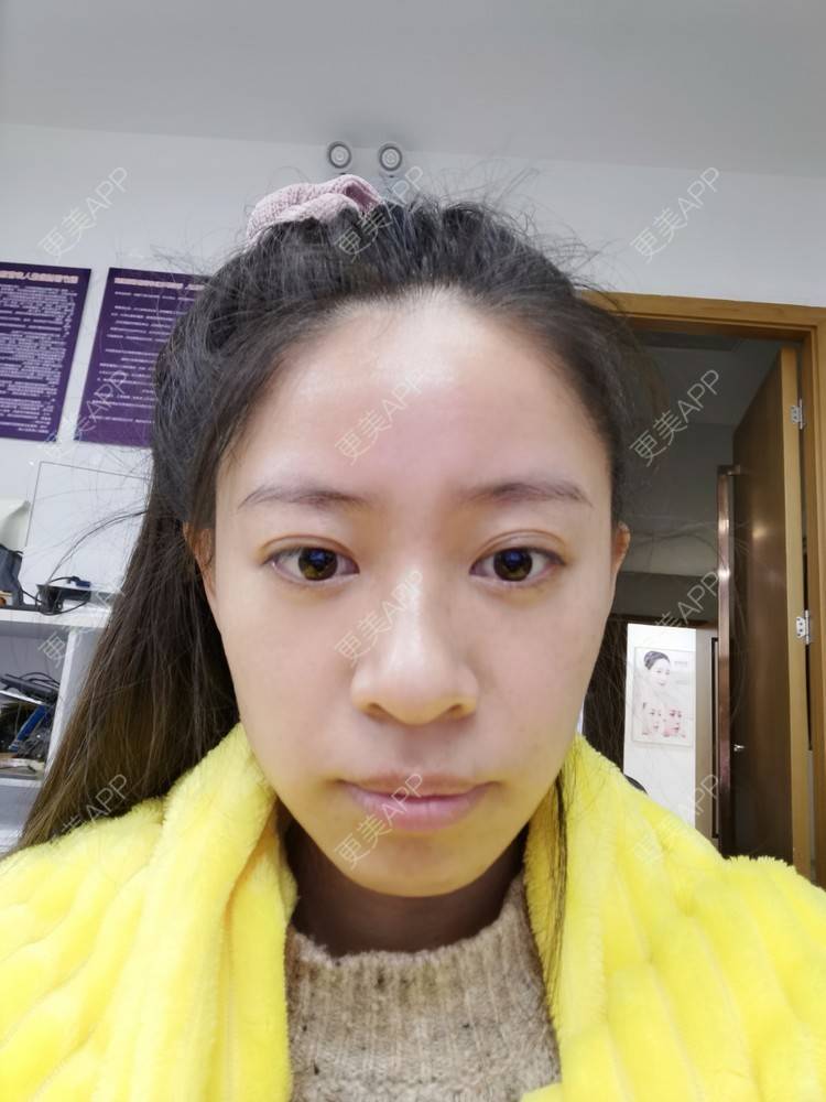 更美 - 更美用户FKgNeqD2Py的黑脸娃娃经验 | 美白套餐 | 白瓷娃娃 | 光子嫩肤 | 彩光嫩肤 | 黑脸娃娃 | 重庆 | 点阵激光 | 注射美白 | 镭射净肤 | 果酸焕肤 | 激光淡斑