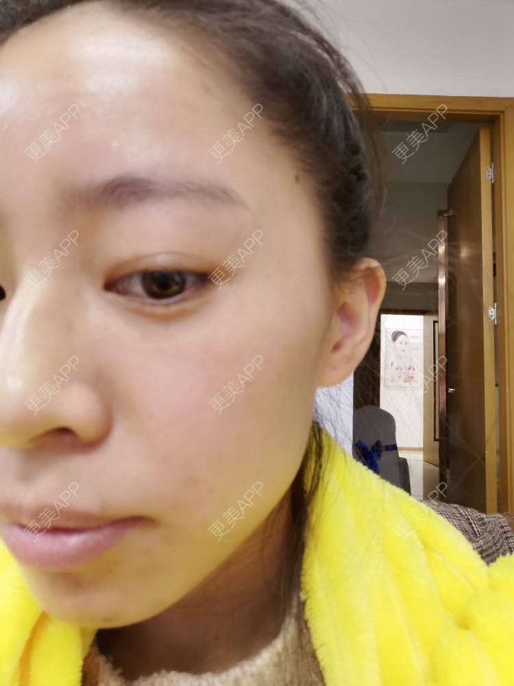 更美 - 更美用户FKgNeqD2Py的黑脸娃娃经验 | 美白套餐 | 白瓷娃娃 | 光子嫩肤 | 彩光嫩肤 | 黑脸娃娃 | 重庆 | 点阵激光 | 注射美白 | 镭射净肤 | 果酸焕肤 | 激光淡斑