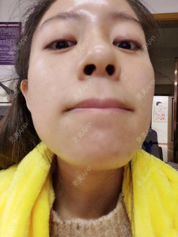 更美 - 更美用户FKgNeqD2Py的黑脸娃娃经验 | 美白套餐 | 白瓷娃娃 | 光子嫩肤 | 彩光嫩肤 | 黑脸娃娃 | 重庆 | 点阵激光 | 注射美白 | 镭射净肤 | 果酸焕肤 | 激光淡斑
