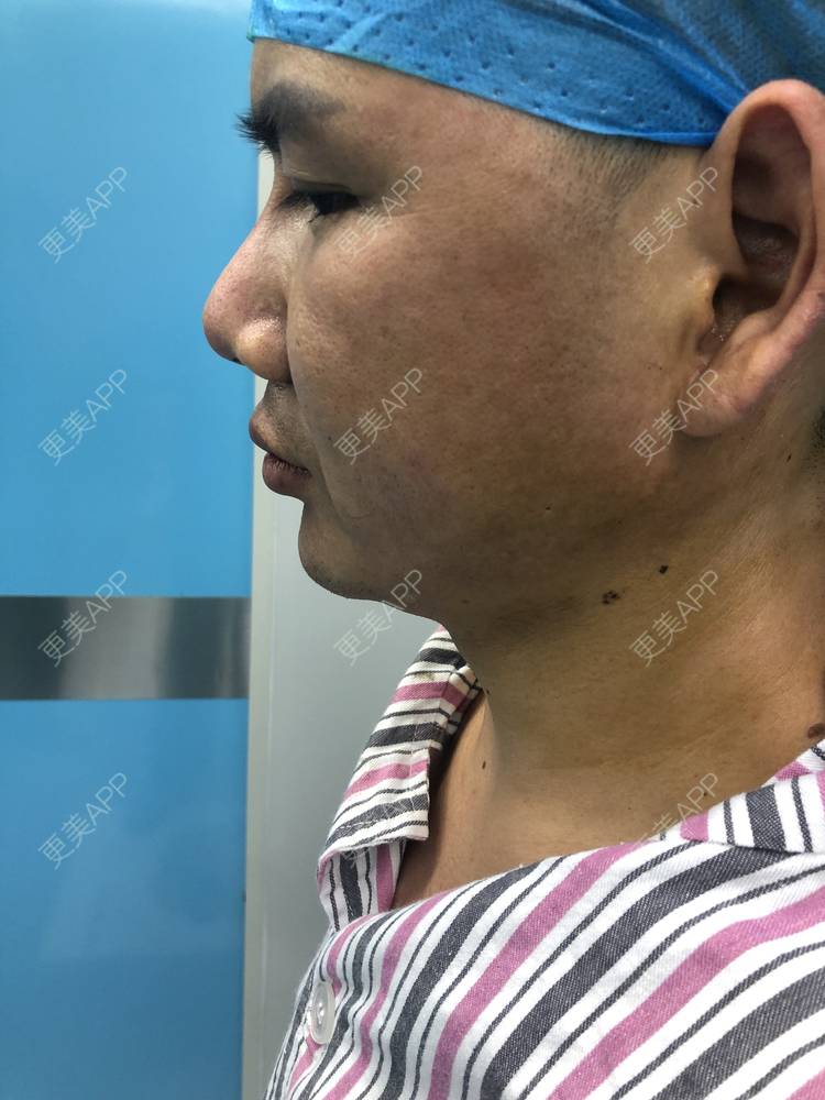 更美 - 更美用户UFWrZulfk8的膨体垫下巴经验 | 膨体垫下巴