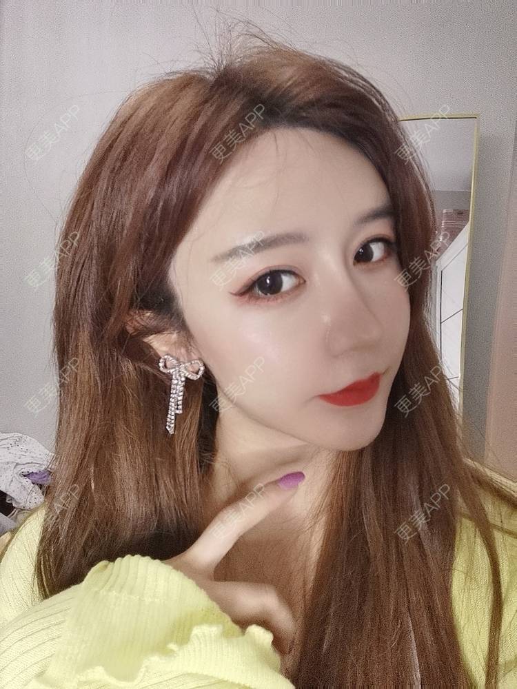 更美 - 素、颜╮浪的自体脂肪全面部填充经验 | 自体脂肪全面部填充 | 南京