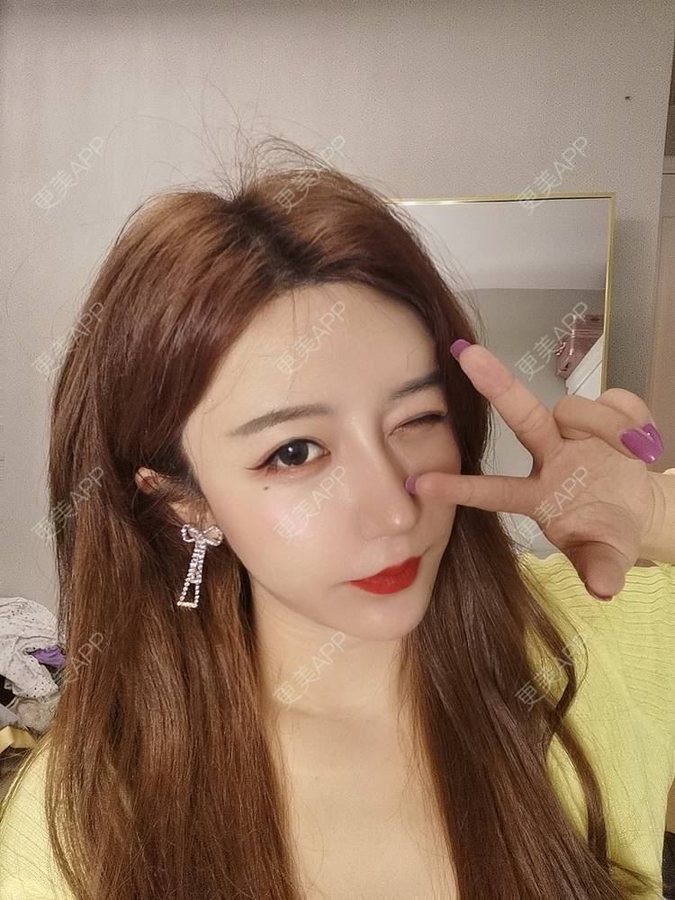 更美 - 素、颜╮浪的自体脂肪全面部填充经验 | 自体脂肪全面部填充 | 南京