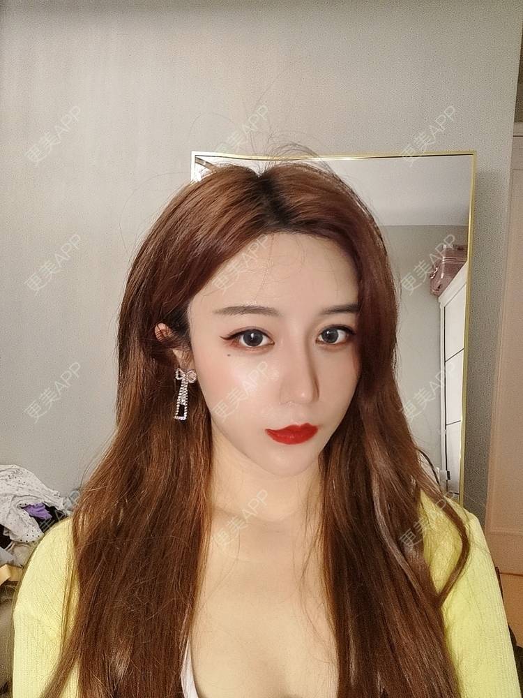 更美 - 素、颜╮浪的自体脂肪全面部填充经验 | 自体脂肪全面部填充 | 南京