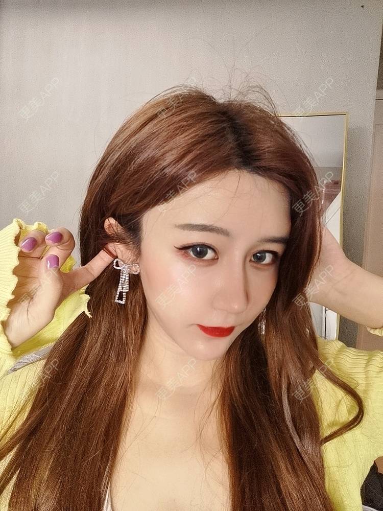 更美 - 素、颜╮浪的自体脂肪全面部填充经验 | 自体脂肪全面部填充 | 南京