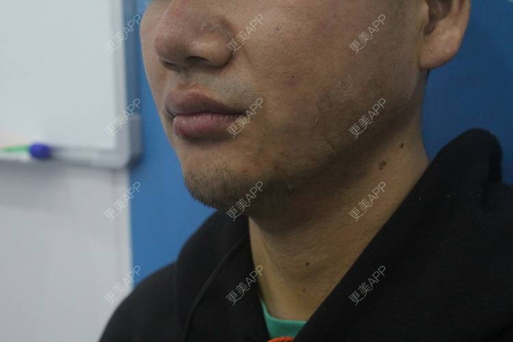 更美 - 更美用户UFWrZulfk8的膨体垫下巴经验 | 膨体垫下巴