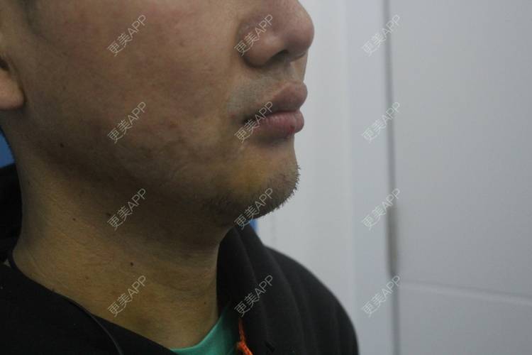 更美 - 更美用户UFWrZulfk8的膨体垫下巴经验 | 膨体垫下巴