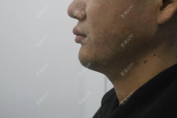 更美 - 更美用户UFWrZulfk8的膨体垫下巴经验 | 膨体垫下巴