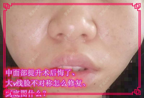 更美 - kris味苮女廖的埋线提升经验 | 北京 | 埋线提升