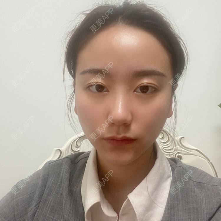 更美 - 原地不动的自体脂肪隆鼻经验 | 自体脂肪隆鼻