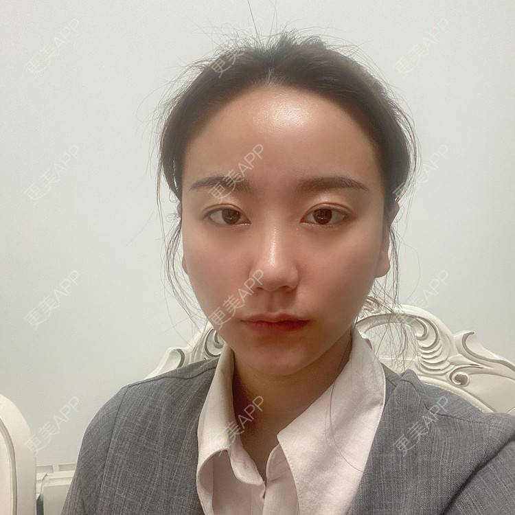 更美 - 原地不动的自体脂肪隆鼻经验 | 自体脂肪隆鼻