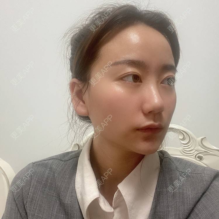 更美 - 原地不动的自体脂肪隆鼻经验 | 自体脂肪隆鼻