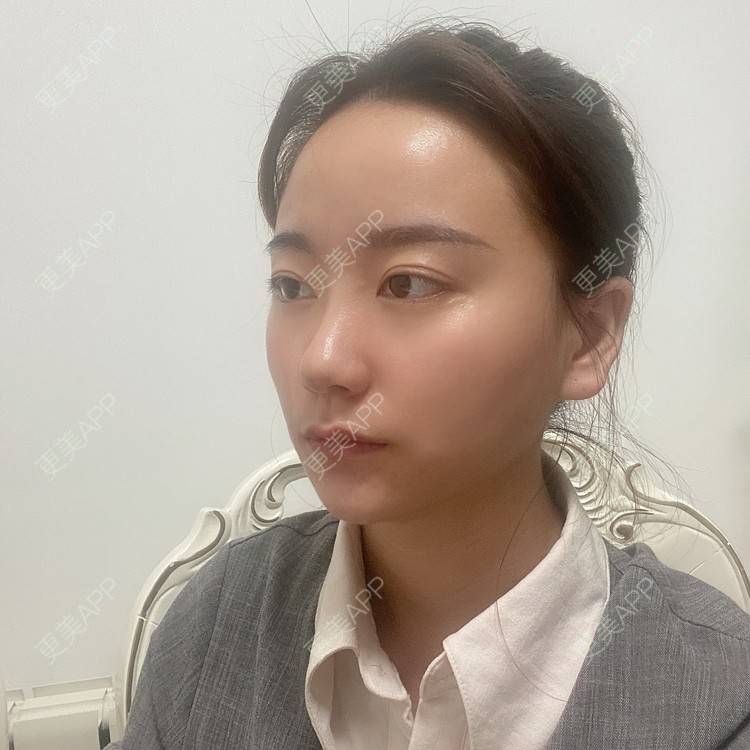 更美 - 原地不动的自体脂肪隆鼻经验 | 自体脂肪隆鼻