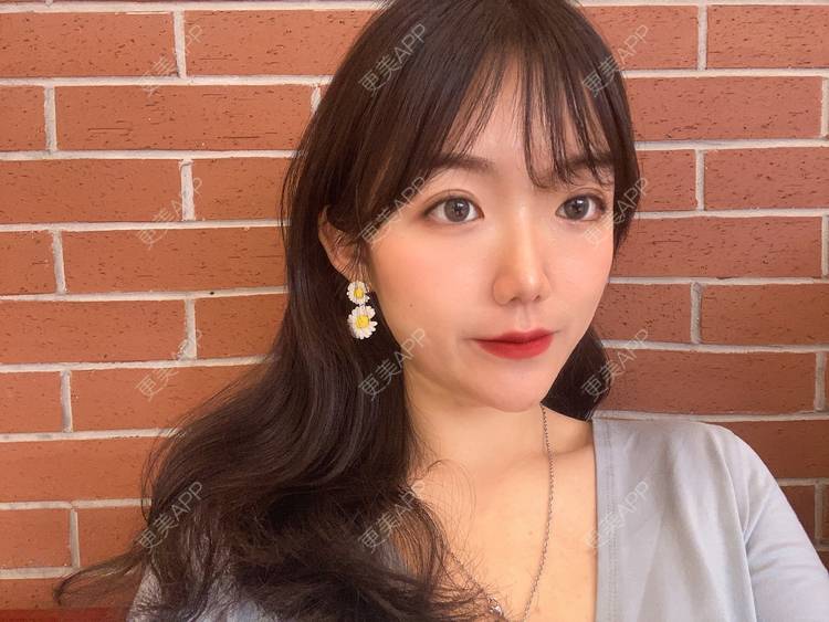 更美 - 镜子里你哭了.展的全切双眼皮经验 | 全切双眼皮 | 成都 | 眶隔脂肪释放 | 眼部多项