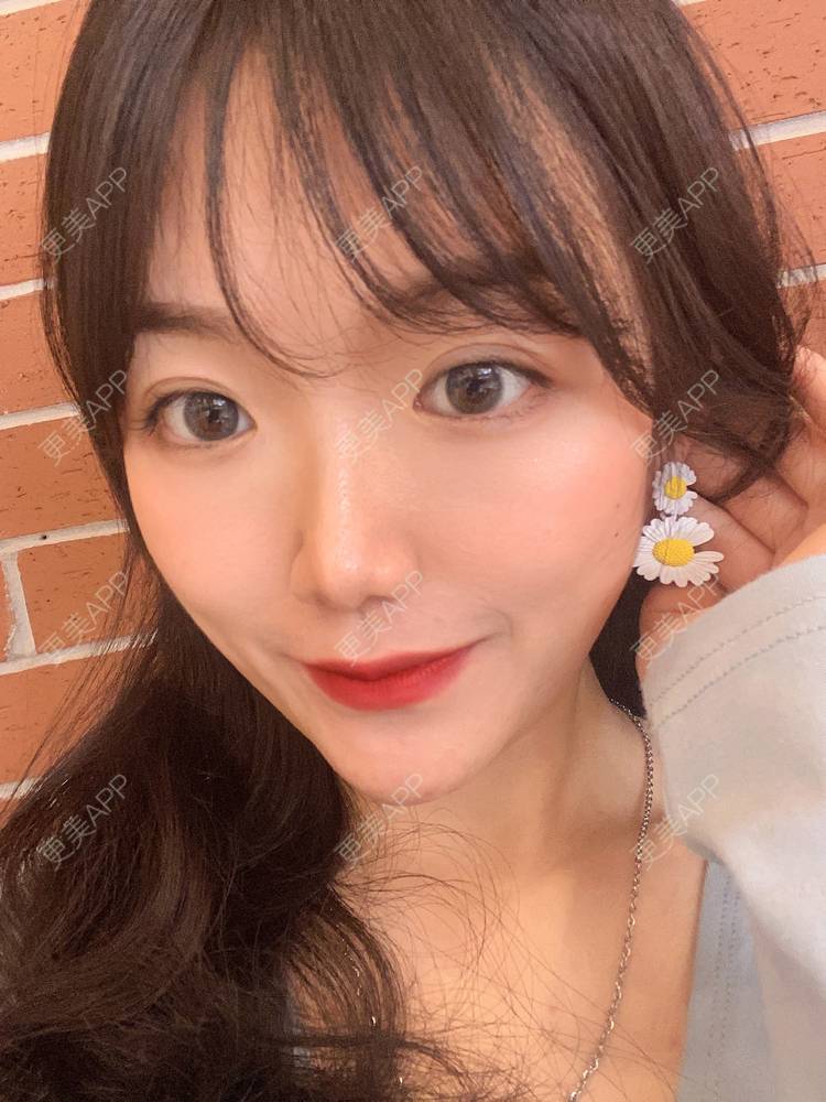 更美 - 镜子里你哭了.展的全切双眼皮经验 | 全切双眼皮 | 成都 | 眶隔脂肪释放 | 眼部多项