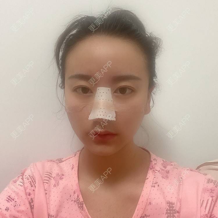 更美 - 原地不动的自体脂肪隆鼻经验 | 自体脂肪隆鼻 | 鼻部综合