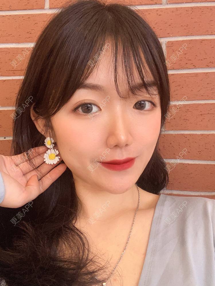 更美 - 镜子里你哭了.展的全切双眼皮经验 | 全切双眼皮 | 成都 | 眶隔脂肪释放 | 眼部多项