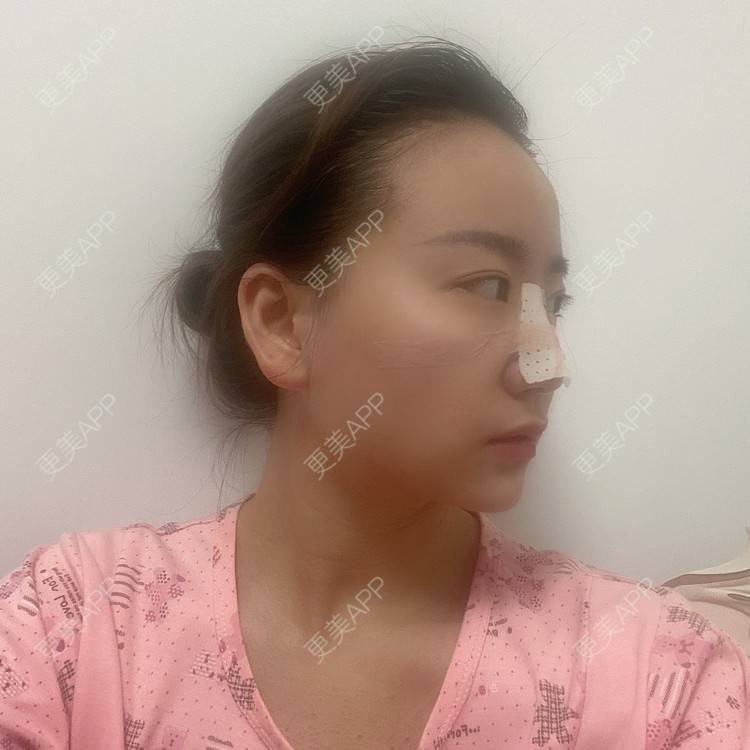 更美 - 原地不动的自体脂肪隆鼻经验 | 自体脂肪隆鼻 | 鼻部综合