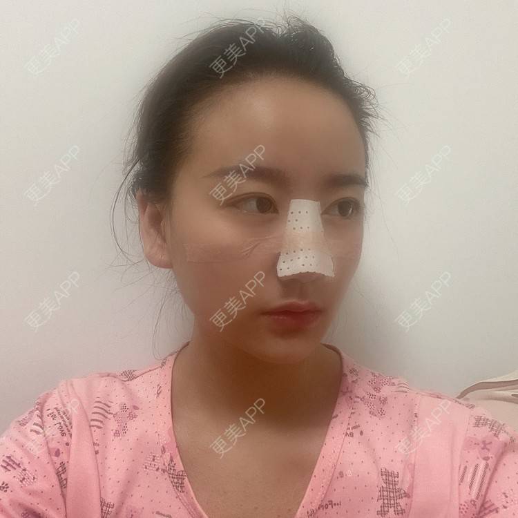 更美 - 原地不动的自体脂肪隆鼻经验 | 自体脂肪隆鼻 | 鼻部综合