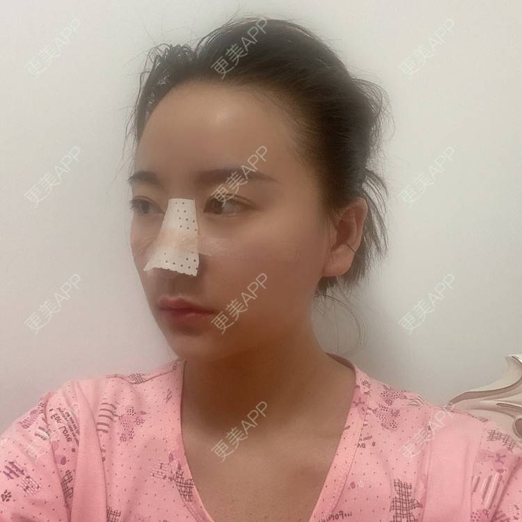 更美 - 原地不动的自体脂肪隆鼻经验 | 自体脂肪隆鼻 | 鼻部综合