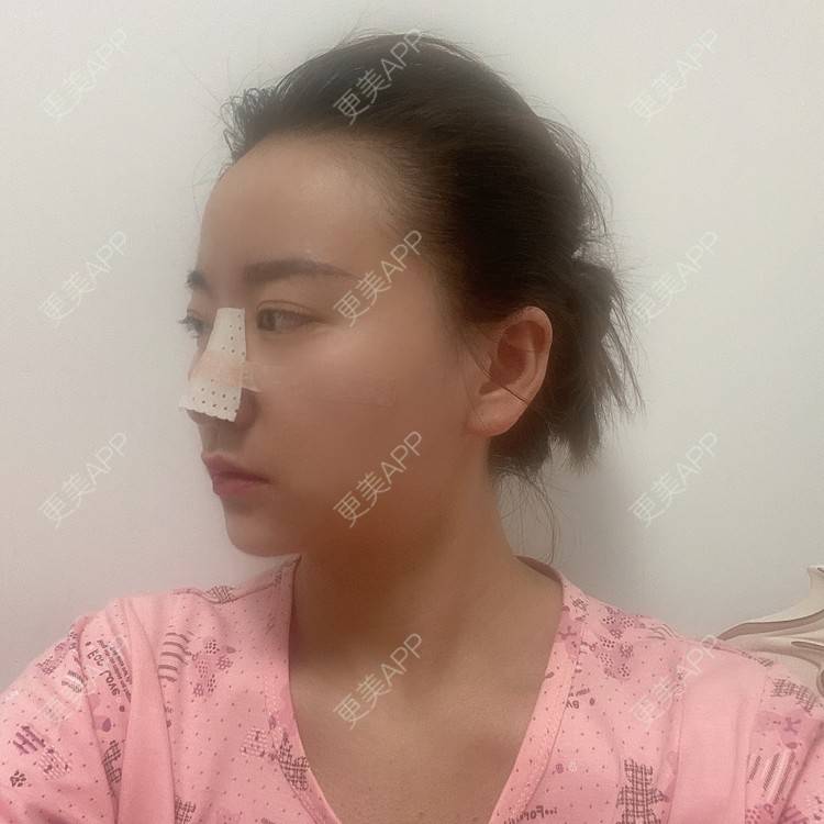 更美 - 原地不动的自体脂肪隆鼻经验 | 自体脂肪隆鼻 | 鼻部综合