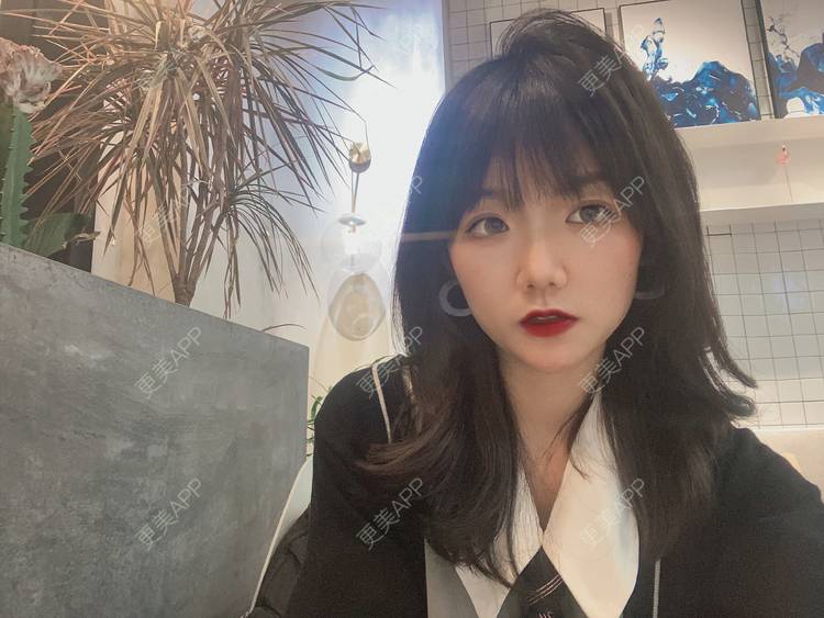 更美 - 镜子里你哭了.展的全切双眼皮经验 | 全切双眼皮 | 成都 | 眶隔脂肪释放 | 眼部多项