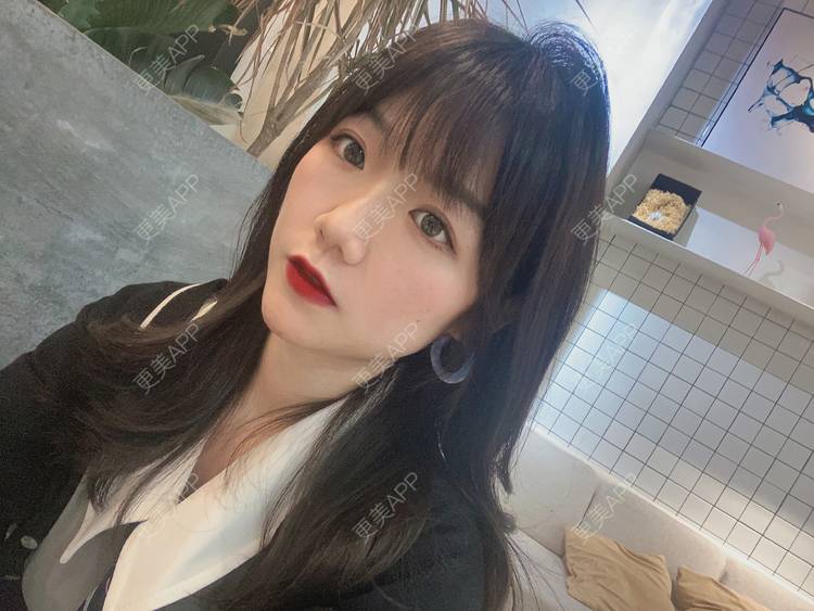 更美 - 镜子里你哭了.展的全切双眼皮经验 | 全切双眼皮 | 成都 | 眶隔脂肪释放 | 眼部多项