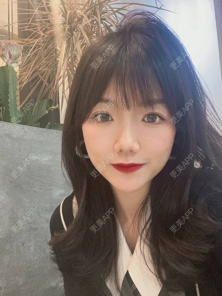 更美 - 镜子里你哭了.展的全切双眼皮经验 | 全切双眼皮 | 成都 | 眶隔脂肪释放 | 眼部多项