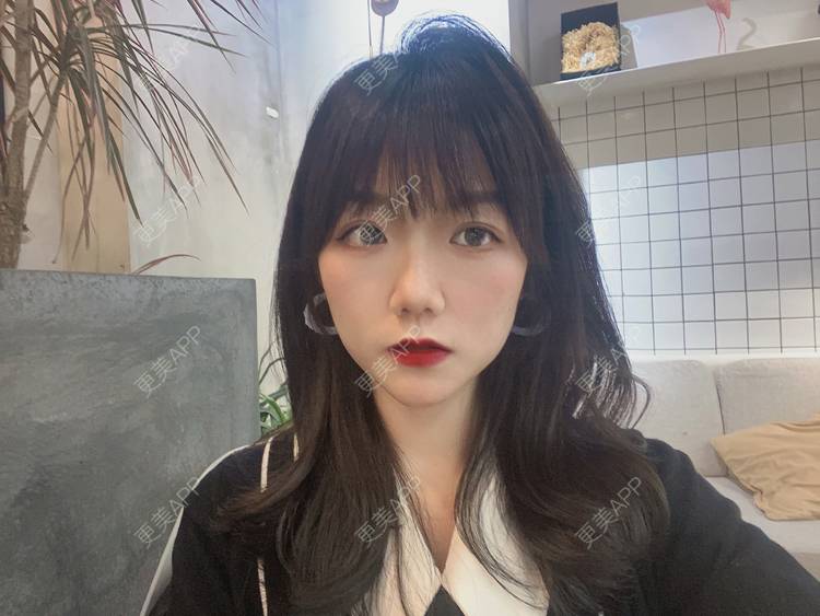 更美 - 镜子里你哭了.展的全切双眼皮经验 | 全切双眼皮 | 成都 | 眶隔脂肪释放 | 眼部多项