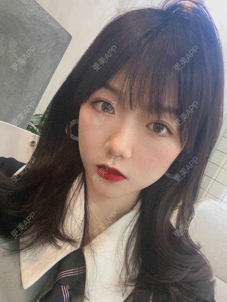 更美 - 镜子里你哭了.展的全切双眼皮经验 | 全切双眼皮 | 成都 | 眶隔脂肪释放 | 眼部多项