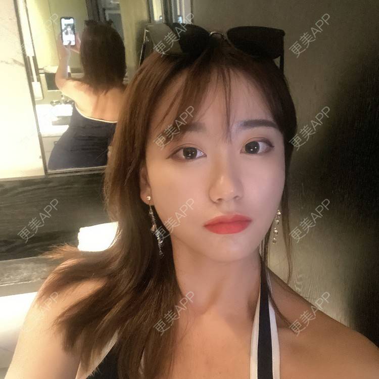 更美 - 原地不动的自体脂肪隆鼻经验 | 自体脂肪隆鼻