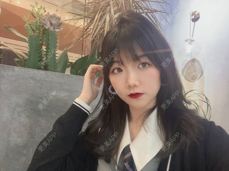 更美 - 镜子里你哭了.展的全切双眼皮经验 | 全切双眼皮 | 成都 | 眶隔脂肪释放 | 眼部多项