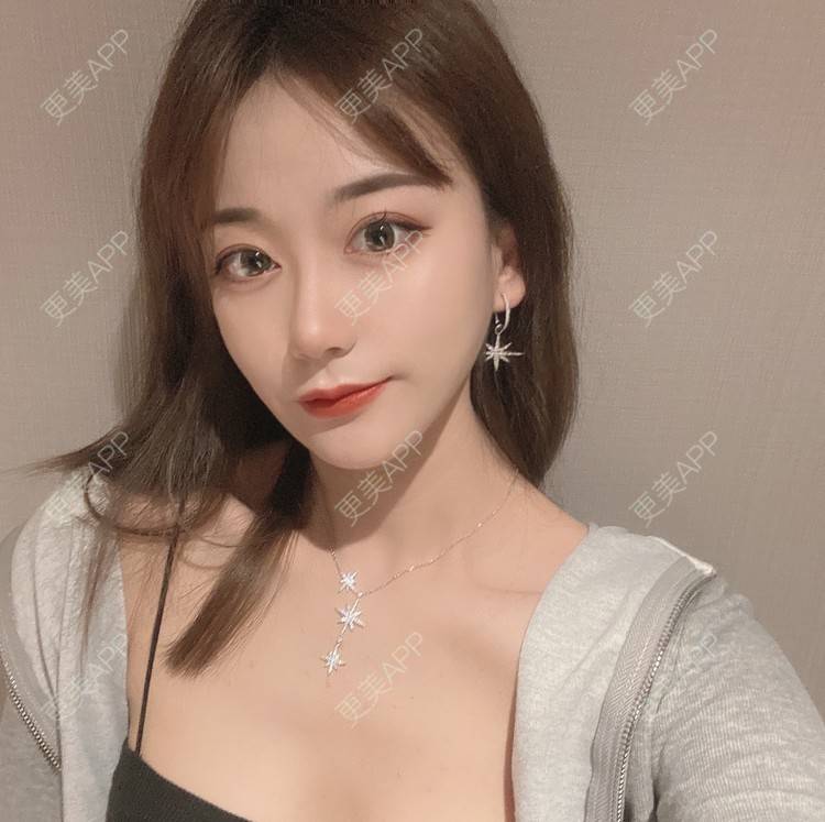 更美 - 原地不动的自体脂肪隆鼻经验 | 自体脂肪隆鼻