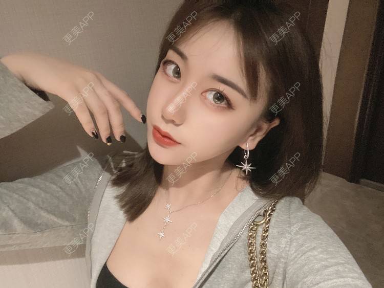 更美 - 原地不动的自体脂肪隆鼻经验 | 自体脂肪隆鼻