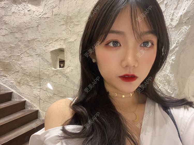 更美 - 镜子里你哭了.展的全切双眼皮经验 | 全切双眼皮 | 成都 | 眶隔脂肪释放 | 眼部多项