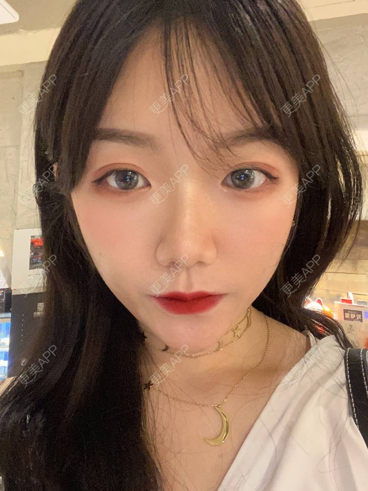 更美 - 镜子里你哭了.展的全切双眼皮经验 | 全切双眼皮 | 成都 | 眶隔脂肪释放 | 眼部多项