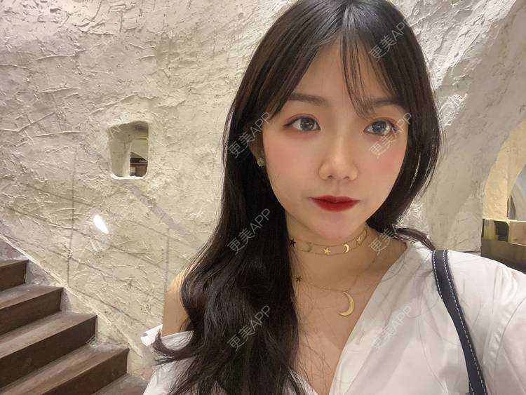 更美 - 镜子里你哭了.展的全切双眼皮经验 | 全切双眼皮 | 成都 | 眶隔脂肪释放 | 眼部多项