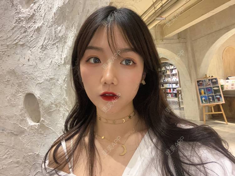 更美 - 镜子里你哭了.展的全切双眼皮经验 | 全切双眼皮 | 成都 | 眶隔脂肪释放 | 眼部多项